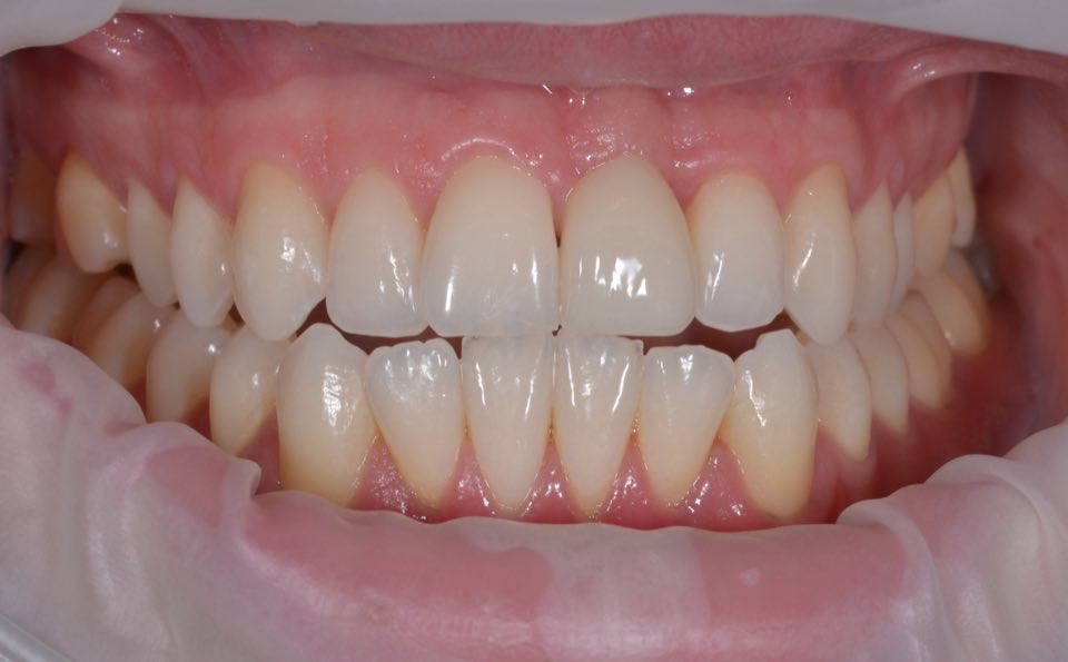 The finished implant crown with the lips held back, showing the gum around the new front tooth.