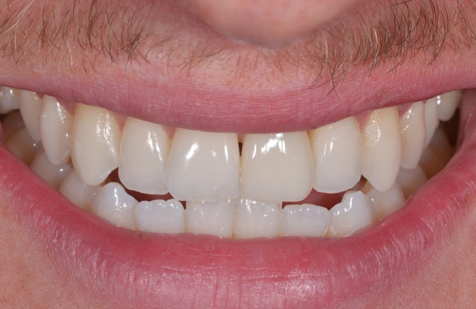 After treatment, smiling from the same view: the gap filled with an implant crown alongside the natural front teeth.