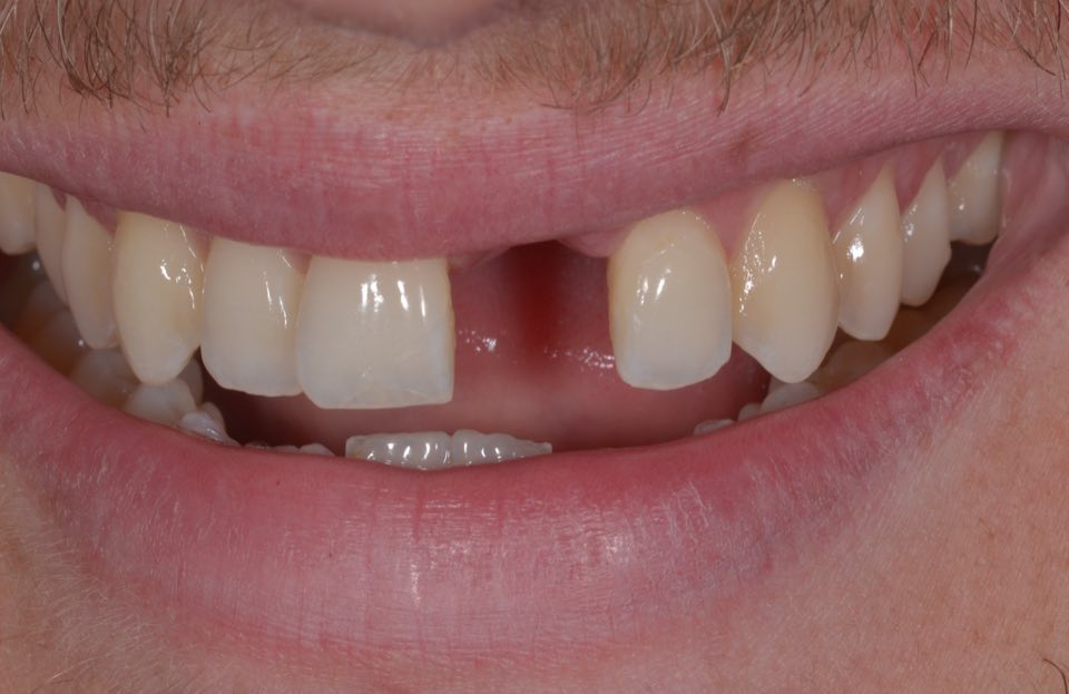 Before treatment, smiling: a gap where an upper front tooth is missing.