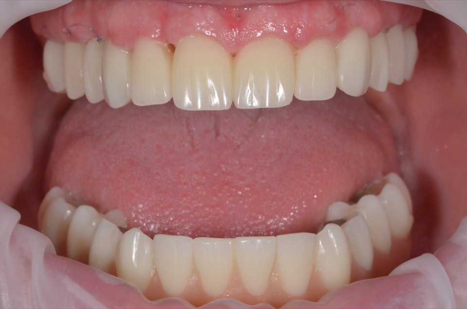 Two weeks after surgery, mouth open: the fixed upper and lower bridges in place, with stitches still visible in the upper gum.