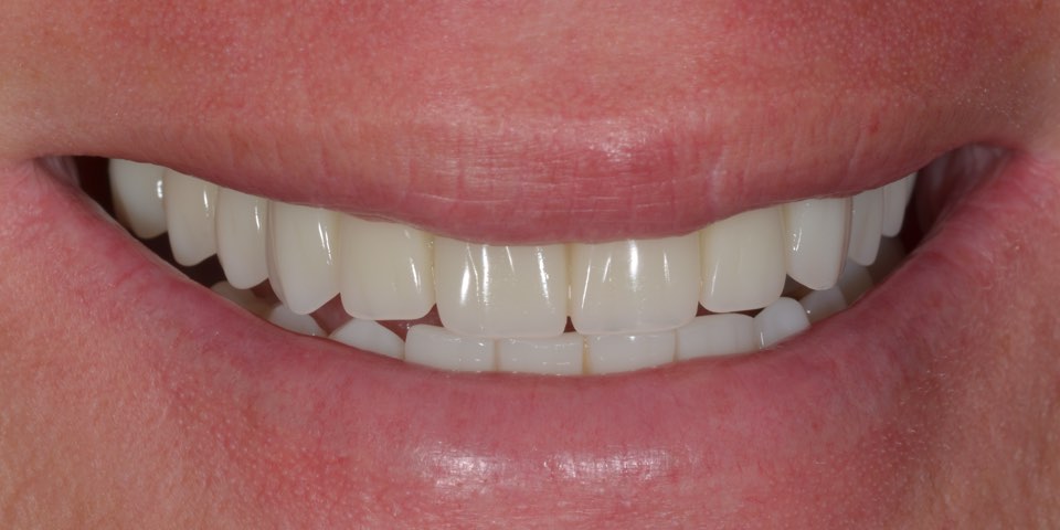 After treatment, smiling from the same view: full upper and lower rows of teeth.