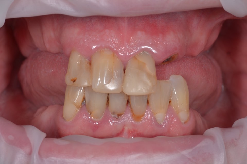 Before treatment, close view: a small number of worn, discoloured and failing upper and lower teeth.