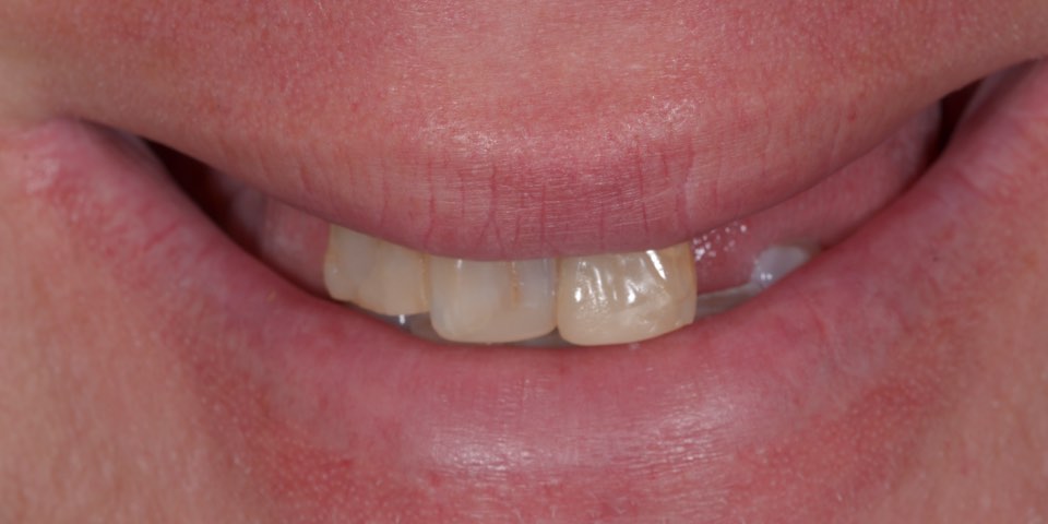 Before treatment, smiling: only a few worn upper front teeth are visible, with gaps either side.