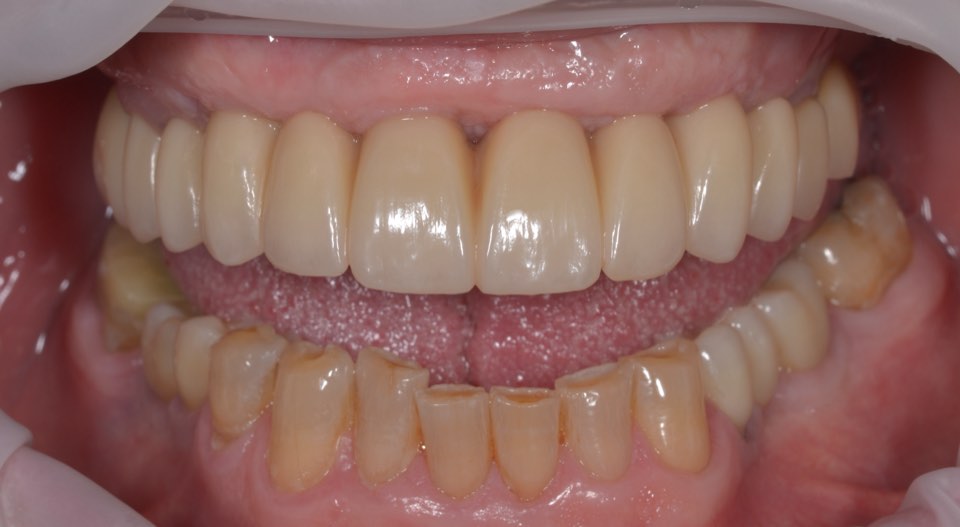 After treatment, close view: the new fixed upper full-arch bridge and the lower back-tooth implant bridges in place.
