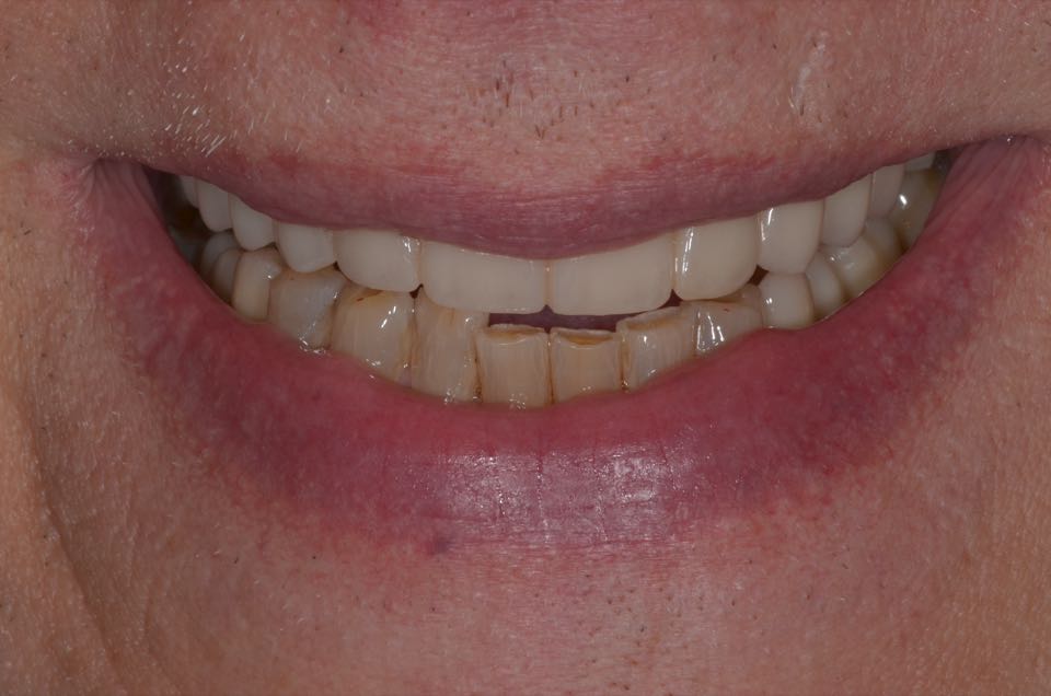 After treatment, smiling from the same view: a full row of new upper teeth.