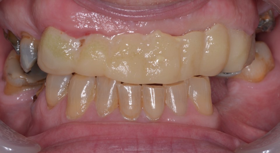 Before treatment, close view: the old upper bridge, broken-down back teeth and missing lower back teeth.