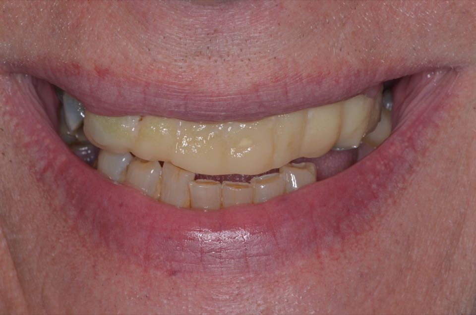 Before treatment, smiling: a worn, discoloured upper bridge with gaps at the back.