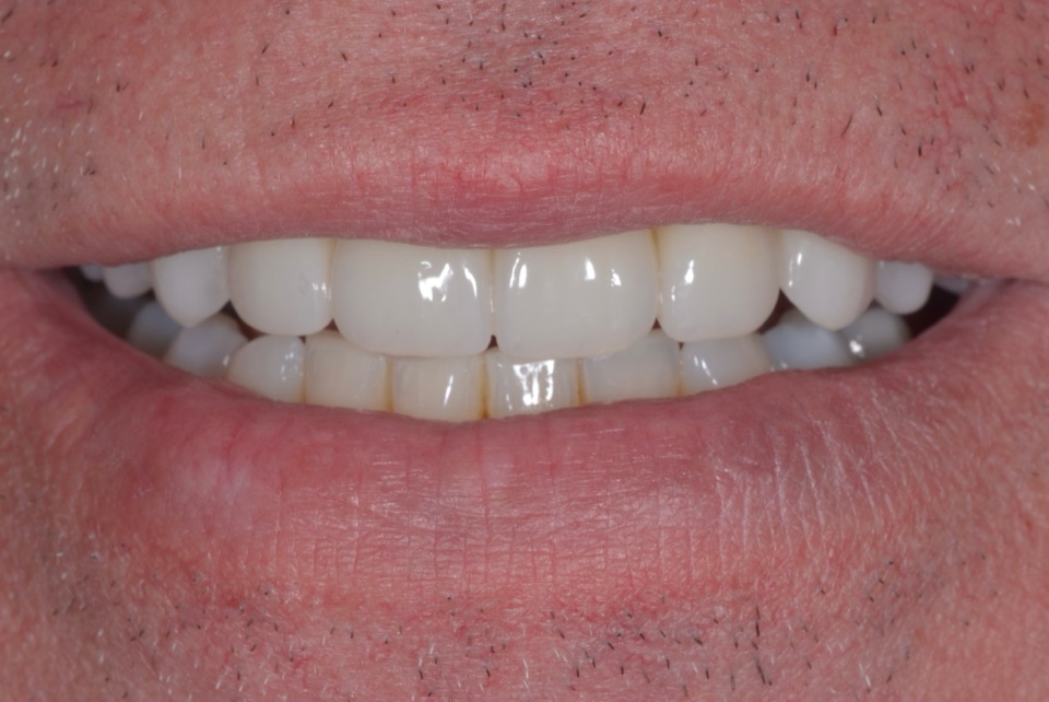 After treatment, photographed from the same view: a complete, even row of upper teeth.