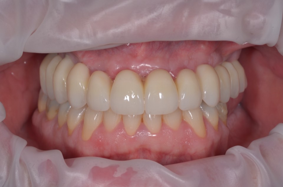 The completed upper arch with the lips gently held back, showing the full row of upper teeth against the natural lower teeth.