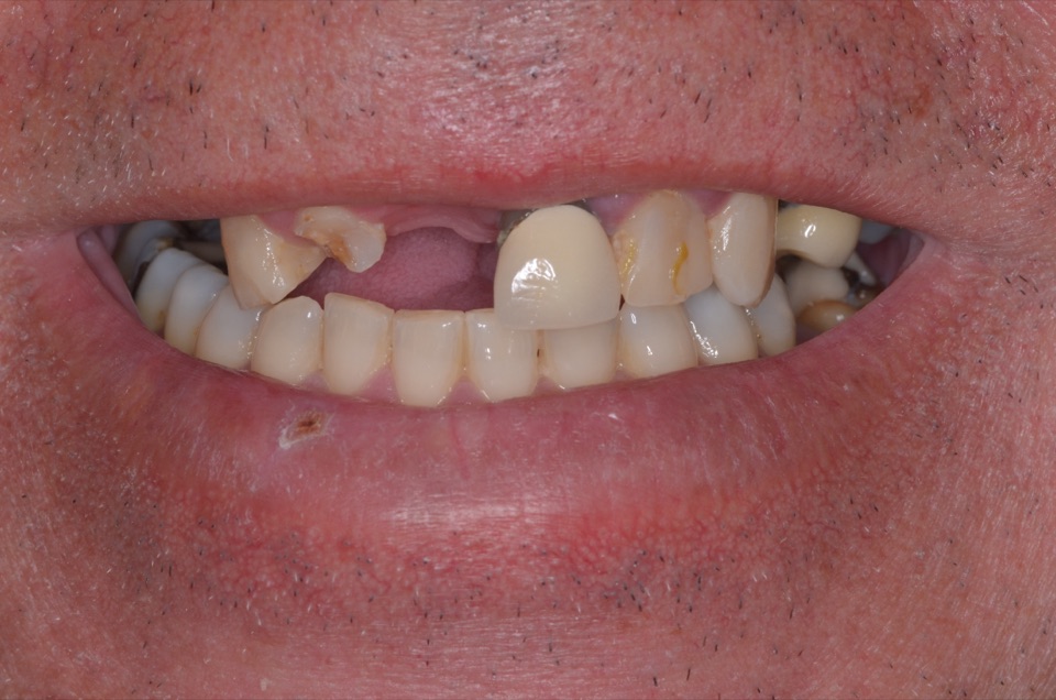 Before treatment: upper teeth broken down and missing, with gaps, an old crown and visible decay.
