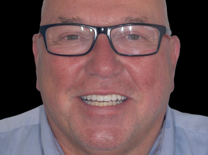 Chris smiling after treatment, photographed from the front.