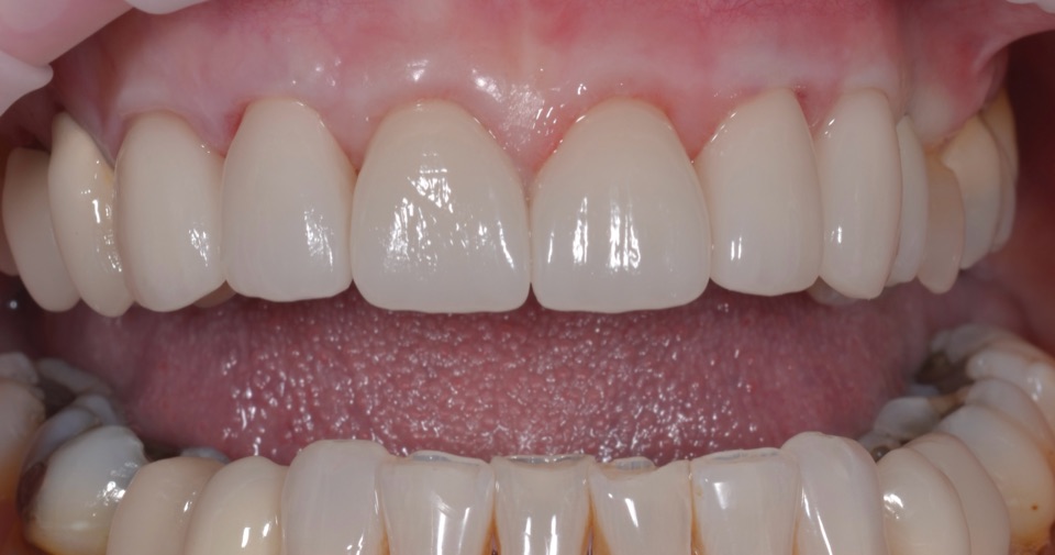 After treatment, close view: the gum line covering the margins of the new upper front restorations.