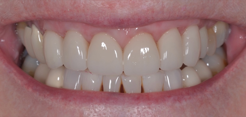 After treatment, smiling from the same view: new restorations on the upper front teeth with healthier gum margins.