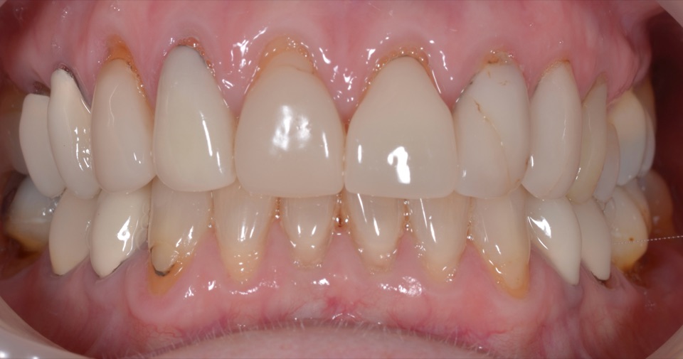 Before treatment, close view: exposed and stained margins where the gums have receded around the upper front restorations.