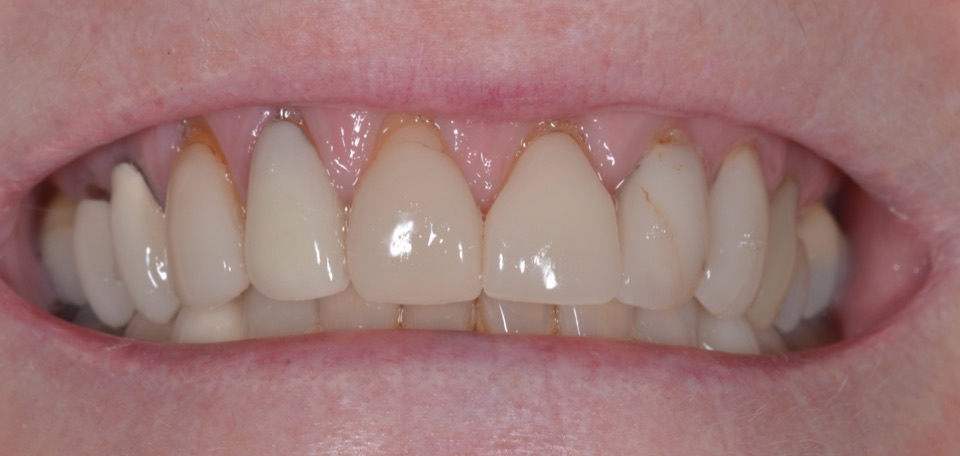 Before treatment, smiling: older restorations on the upper front teeth with discoloured margins and gum recession.