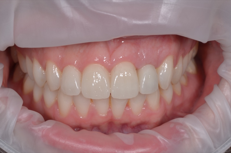 After treatment, photographed from the same view: the upper front teeth restored to a complete, even row.