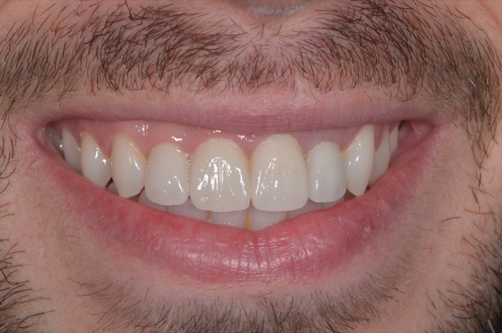 The patient smiling naturally after treatment.