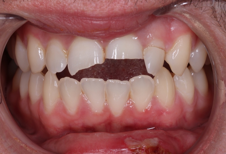 Before treatment: upper front teeth fractured following an injury, with a gap where tooth structure has broken away.