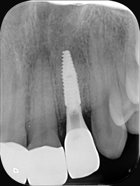 Dental X-ray showing the implant in the upper jaw, with its crown in place.