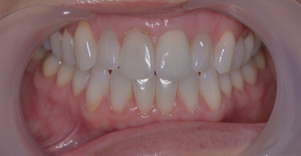 The finished implant crown with the lips held back, showing the gum around the new front tooth.