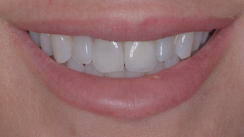 After treatment, smiling from the same view: the gap filled with an implant crown matching the neighbouring front tooth.