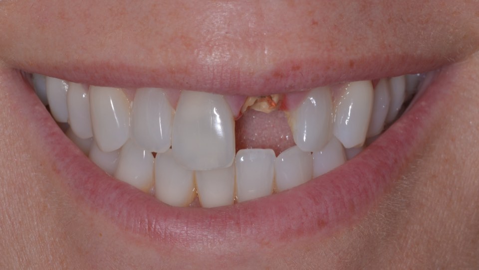Before treatment, smiling: a gap in the upper front teeth where the post crown has come away, leaving a broken root.