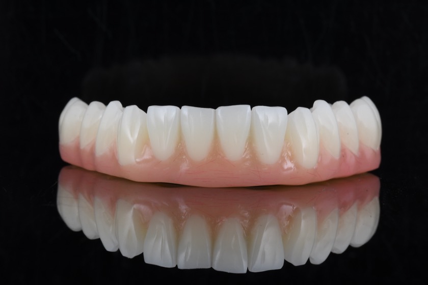 A finished full-arch implant bridge, with a pink gum-toned base supporting a complete row of white teeth.
