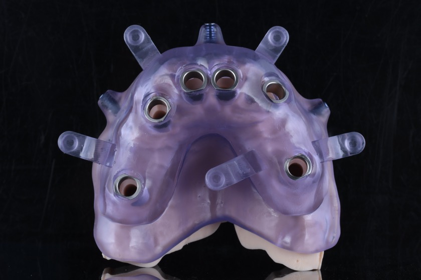 A full-arch surgical guide in clear resin, with metal sleeves marking each planned implant position and anchor-pin tabs around its edge.