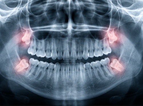 Panoramic dental X-ray with all four wisdom teeth highlighted at the back of the upper and lower jaws.