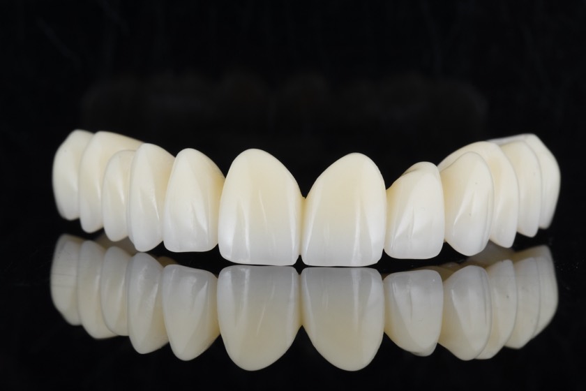 A zirconia implant bridge of upper front teeth, shown without a gum-toned base.